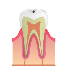 C1:エナメル質のむし歯(初期～中期)