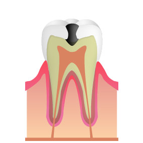 C2:象牙質のむし歯(中期)