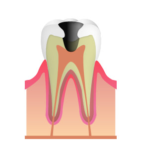 C3:神経にまで達したむし歯(中期～末期)