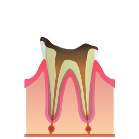 C4:歯根にまで達したむし歯(末期)