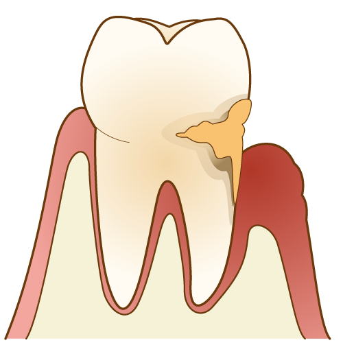 根面う蝕